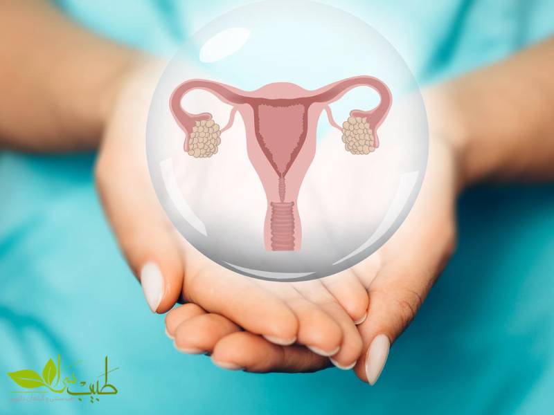 داروهای گیاهی برای کیست تخمدان